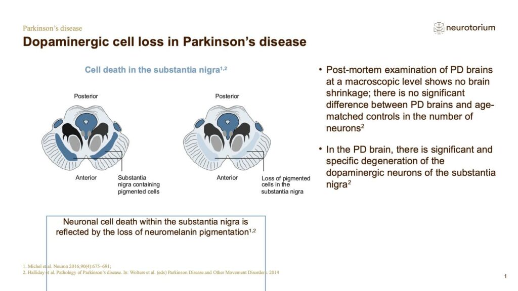 Dopaminergic cell loss in Parkinson’s disease